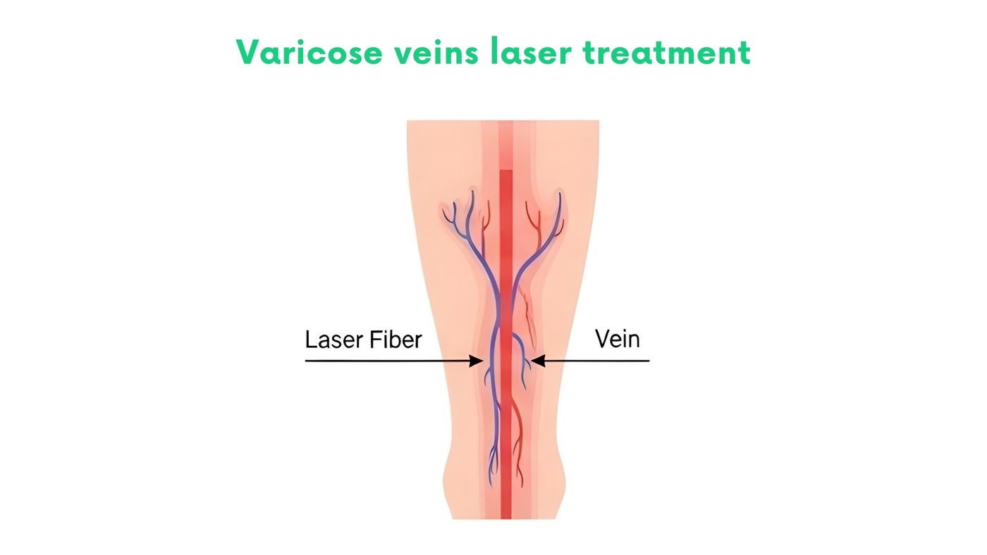 Varicose veins laser treatment by Dr. Shehryar Niazi