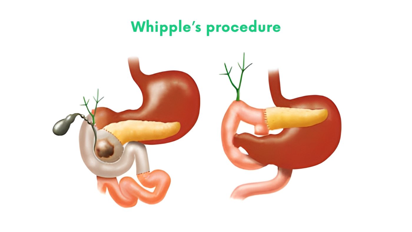 Whipple’s procedure (pancreaticoduodenectomy) by Dr. Shehryar Niazi