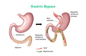 Gastric Bypass