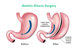 Gastric Sleeve Surgery