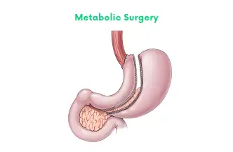 Metabolic Surgery