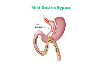 Mini Gastric Bypass