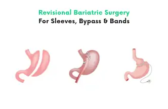 Revisional Bariatric Surgery