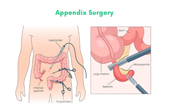 Appendix Surgery