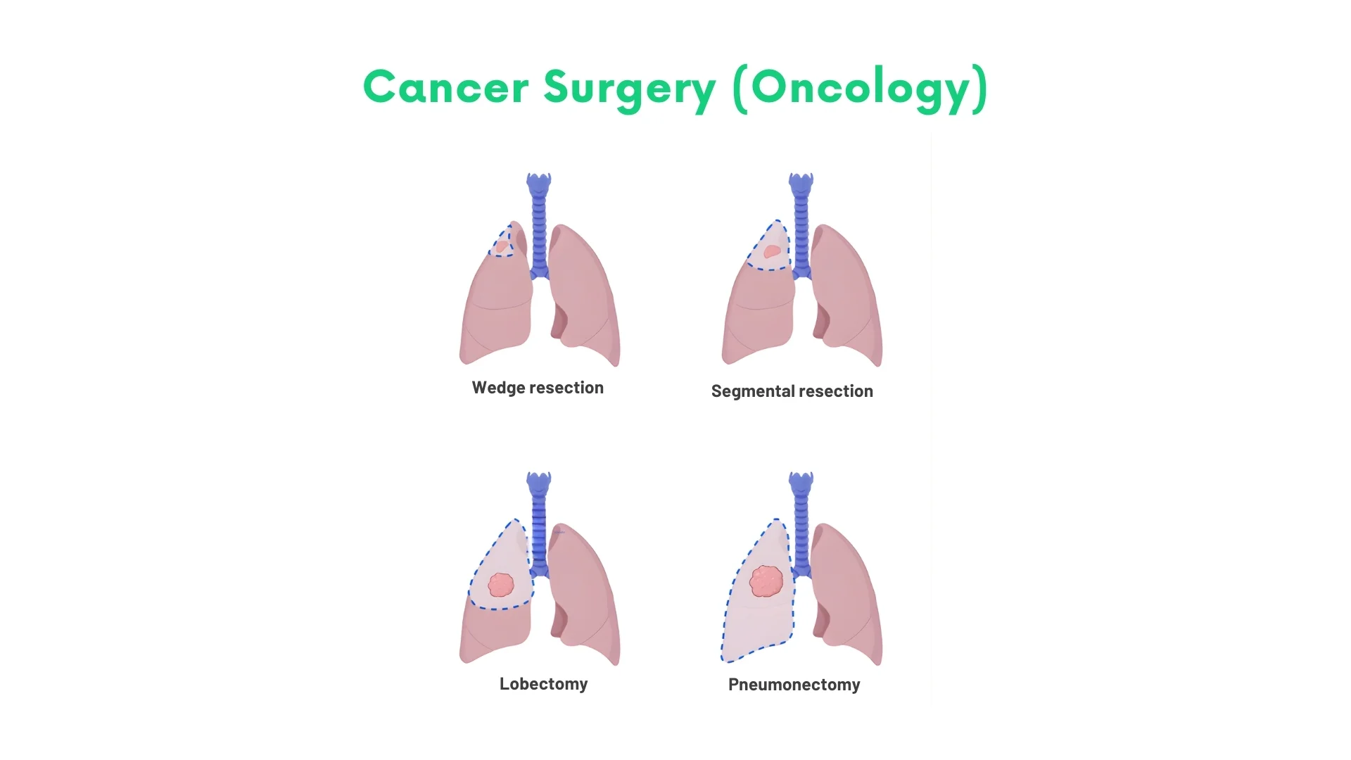 Cancer Surgery (Oncology)