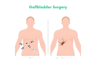Gallbladder Surgery