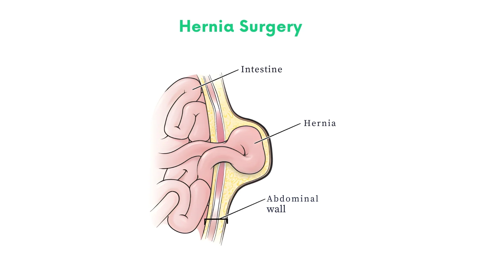 Hernia Surgery