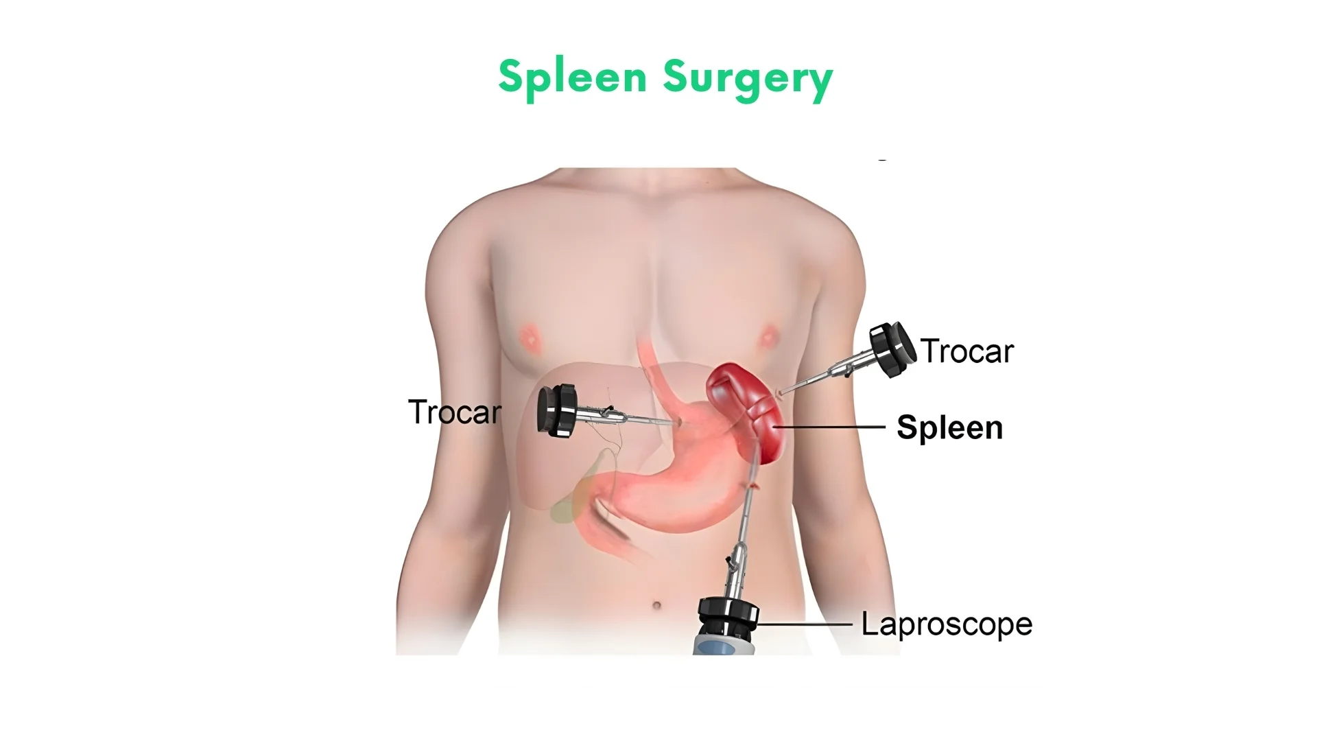 Spleen Surgery