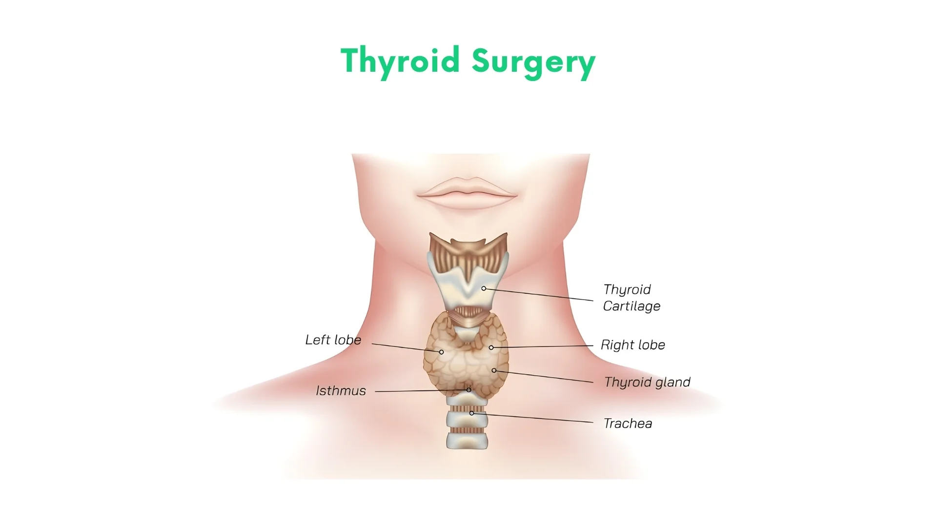 Thyroid Surgery